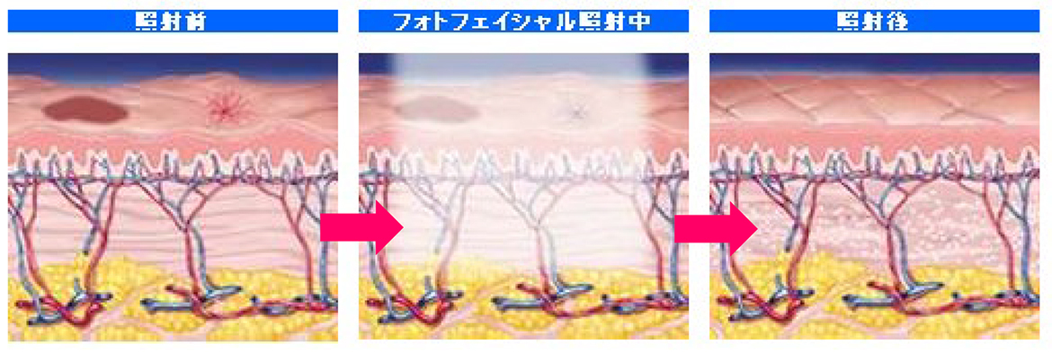 照射前　フォトフェイシャル照射中　照射後