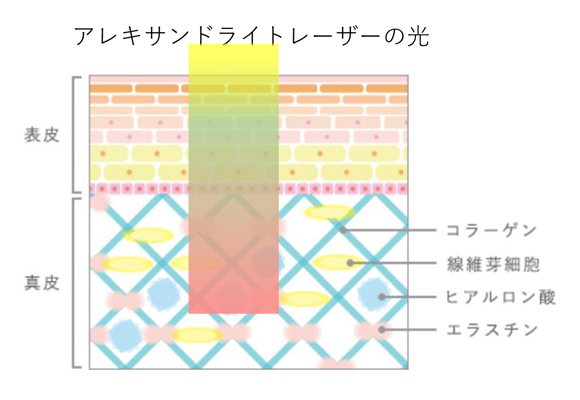 イラスト：肌質改善の治療