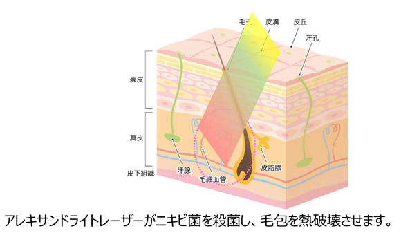 イラスト：ニキビの治療