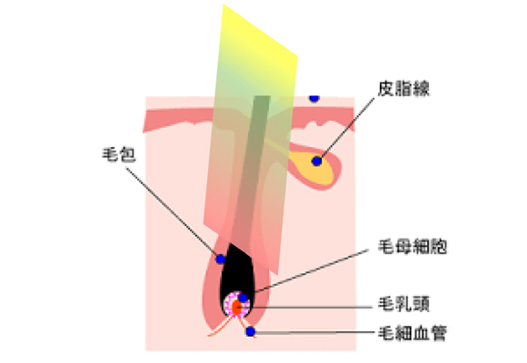 イラスト：脱毛効果