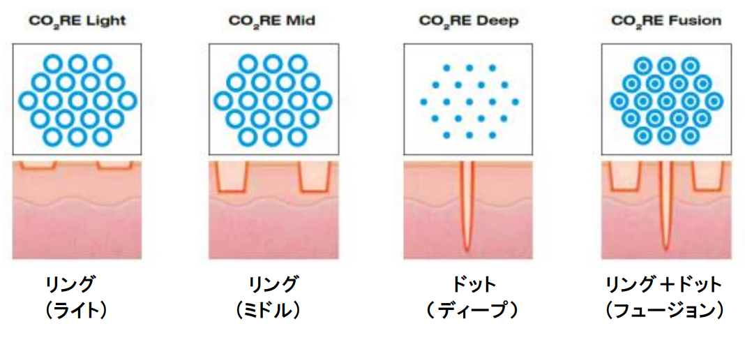 フラクショナルレーザー