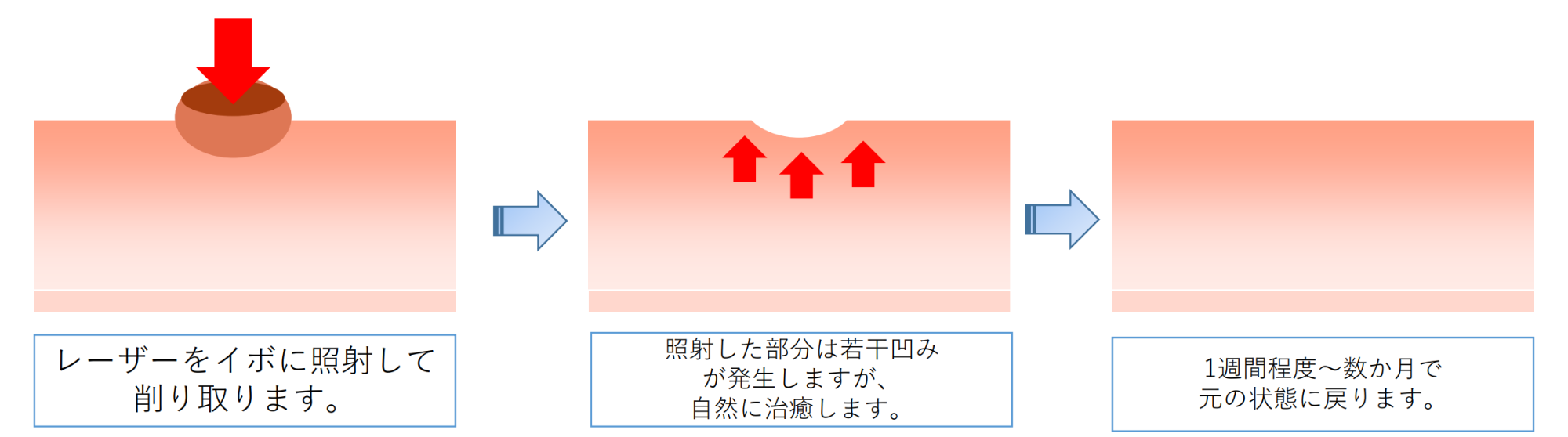 スキャナ付炭酸ガスレーザー