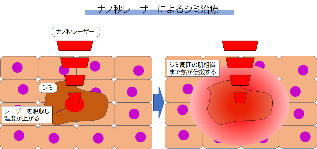 老人性色素班とは？
