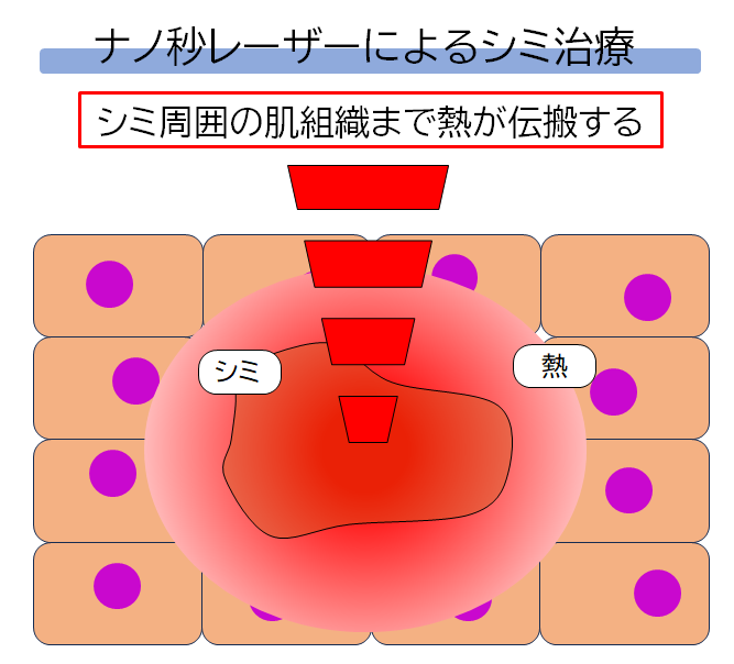 ナノ秒レーザーによるシミ治療