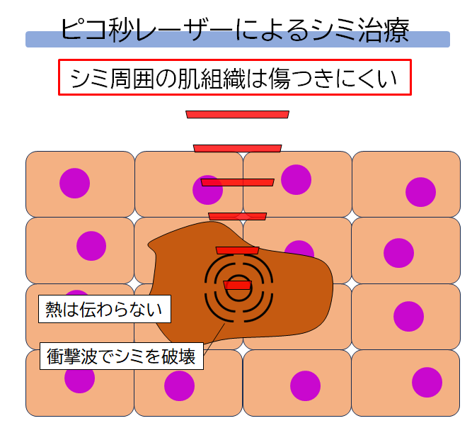 ピコ秒レーザーによるシミ治療